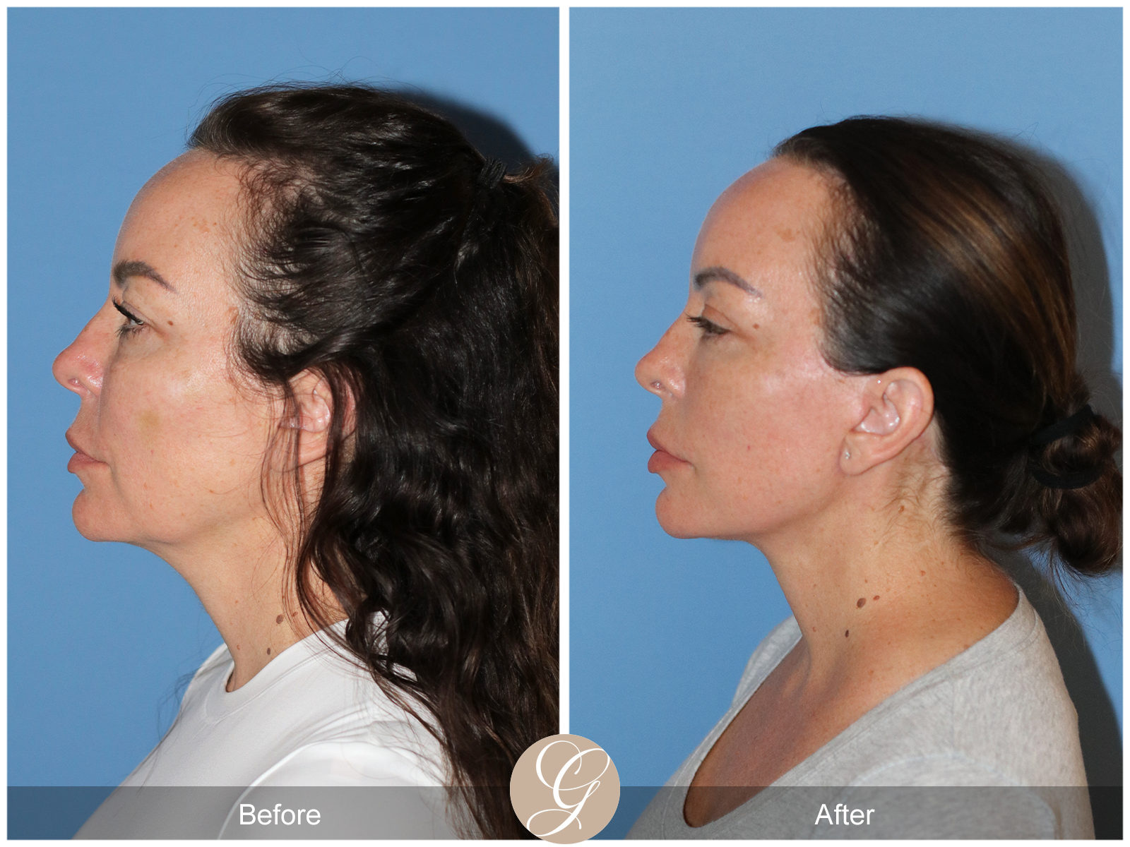Preservation Deep Plane Facelift Case 46 Image