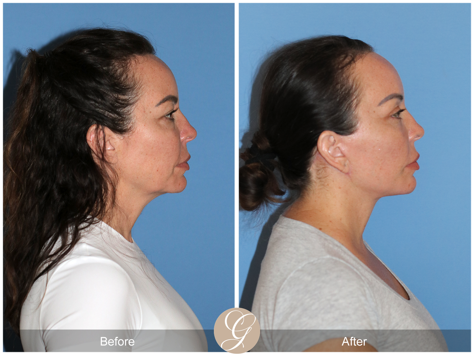 Preservation Deep Plane Facelift Case 46 Image