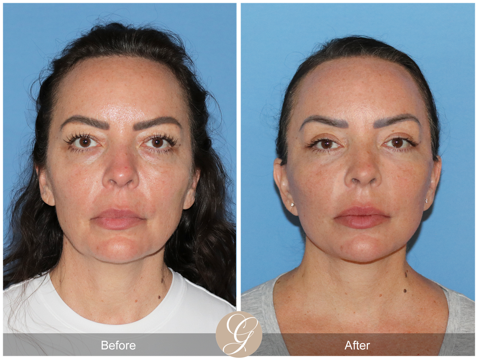 Preservation Deep Plane Facelift Case 46 Image