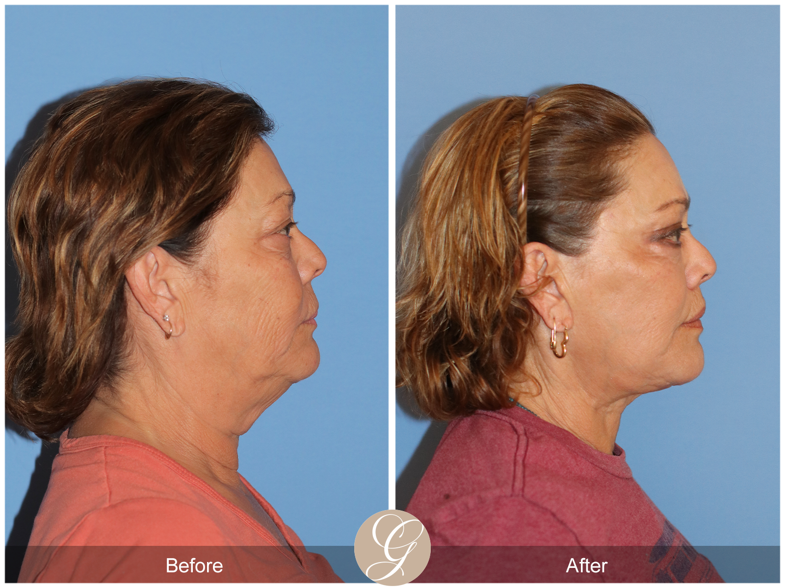 Deep Plane Facelift Case 37 Image