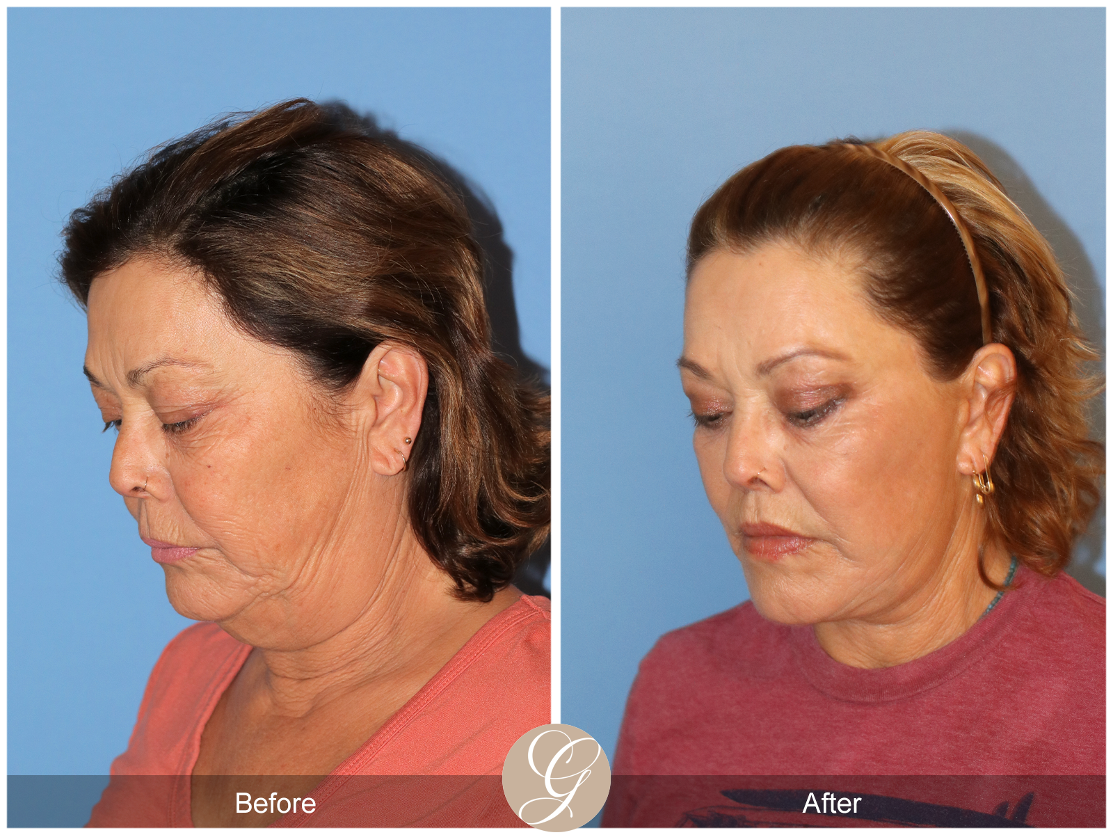 Deep Plane Facelift Case 37 Image