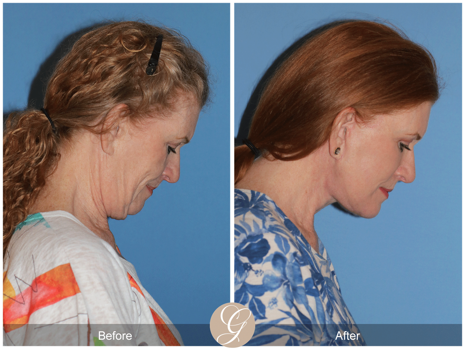 Deep Plane Facelift Case 30 Image