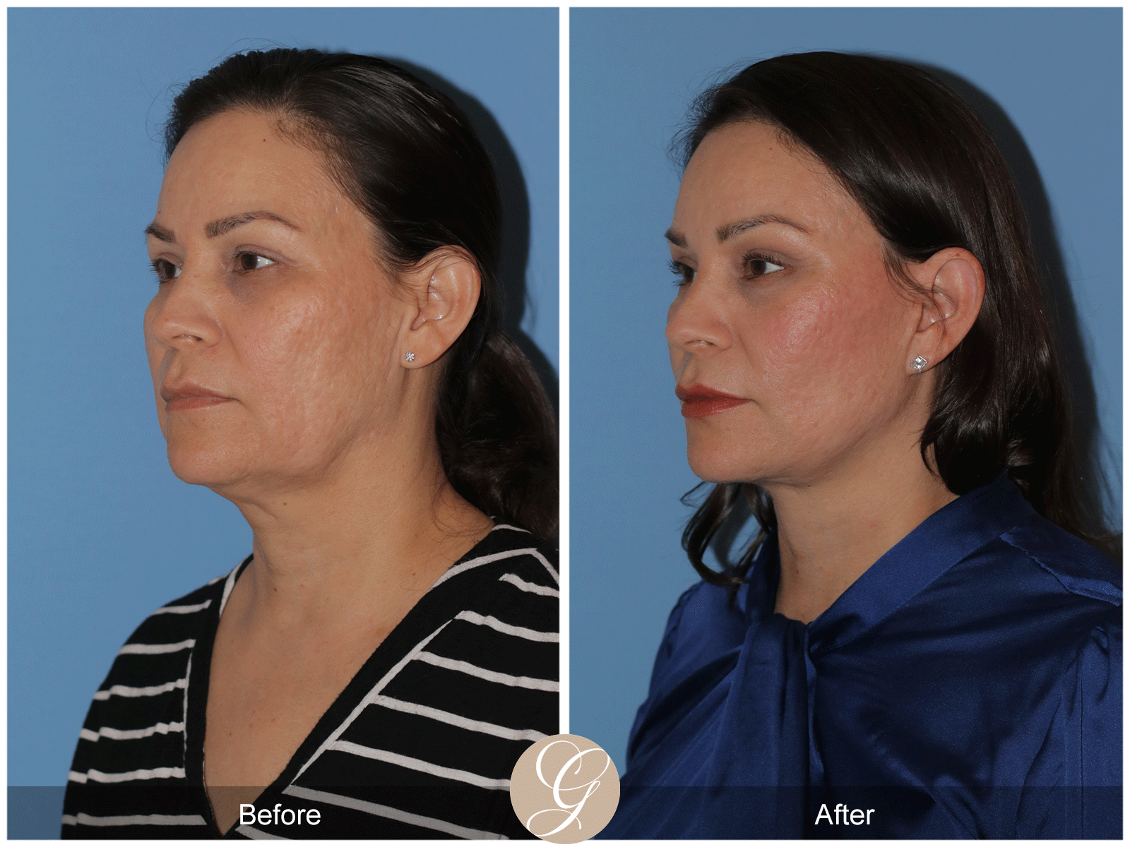 Deep Plane Facelift Case 27 Image
