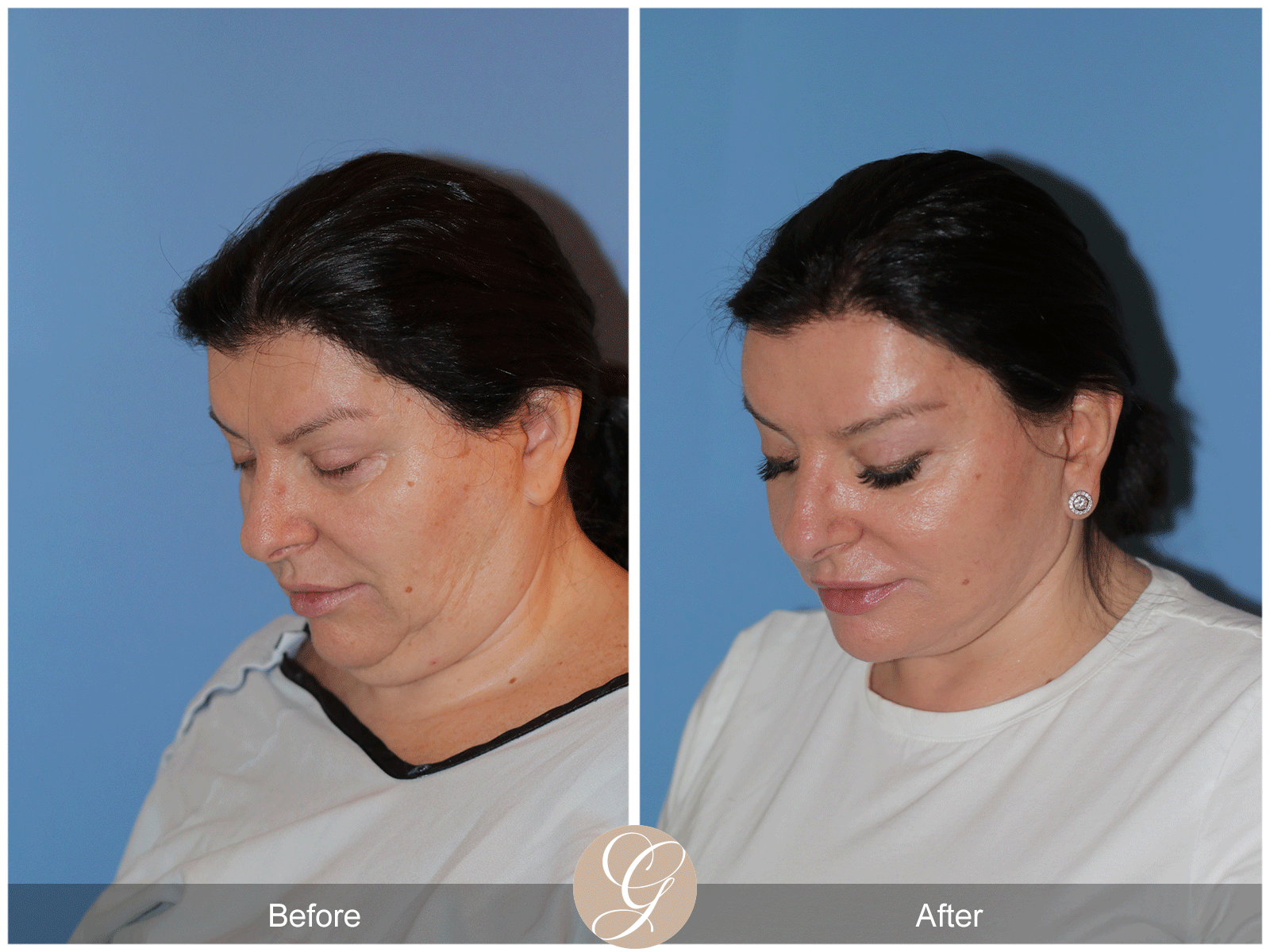 Preservation Deep Plane Facelift Case 40 Image