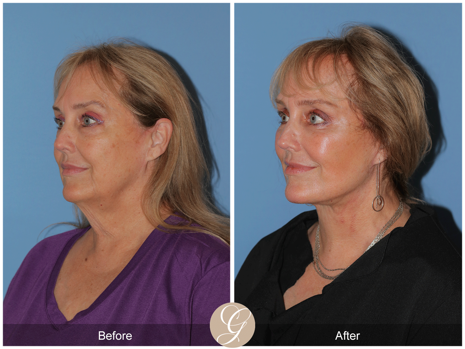 Deep Plane Facelift Case 48 Image