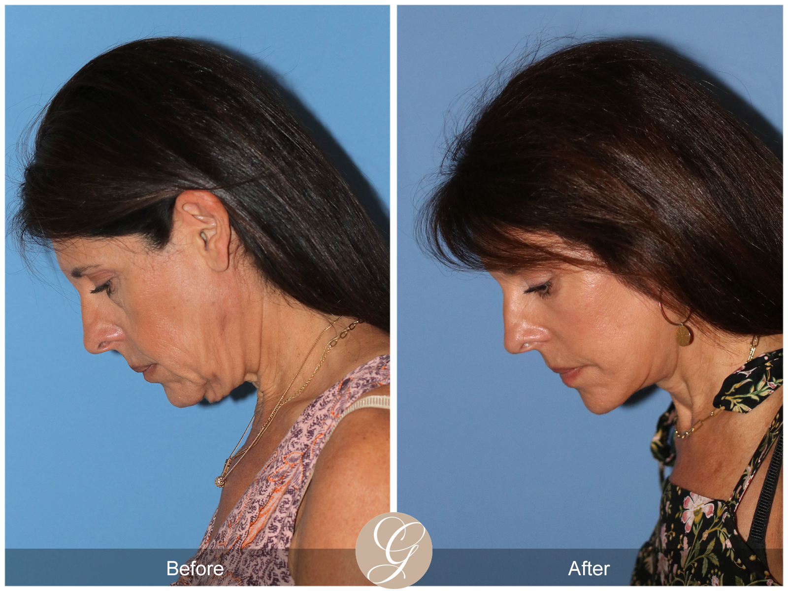 Deep Plane Facelift Case 32 Image