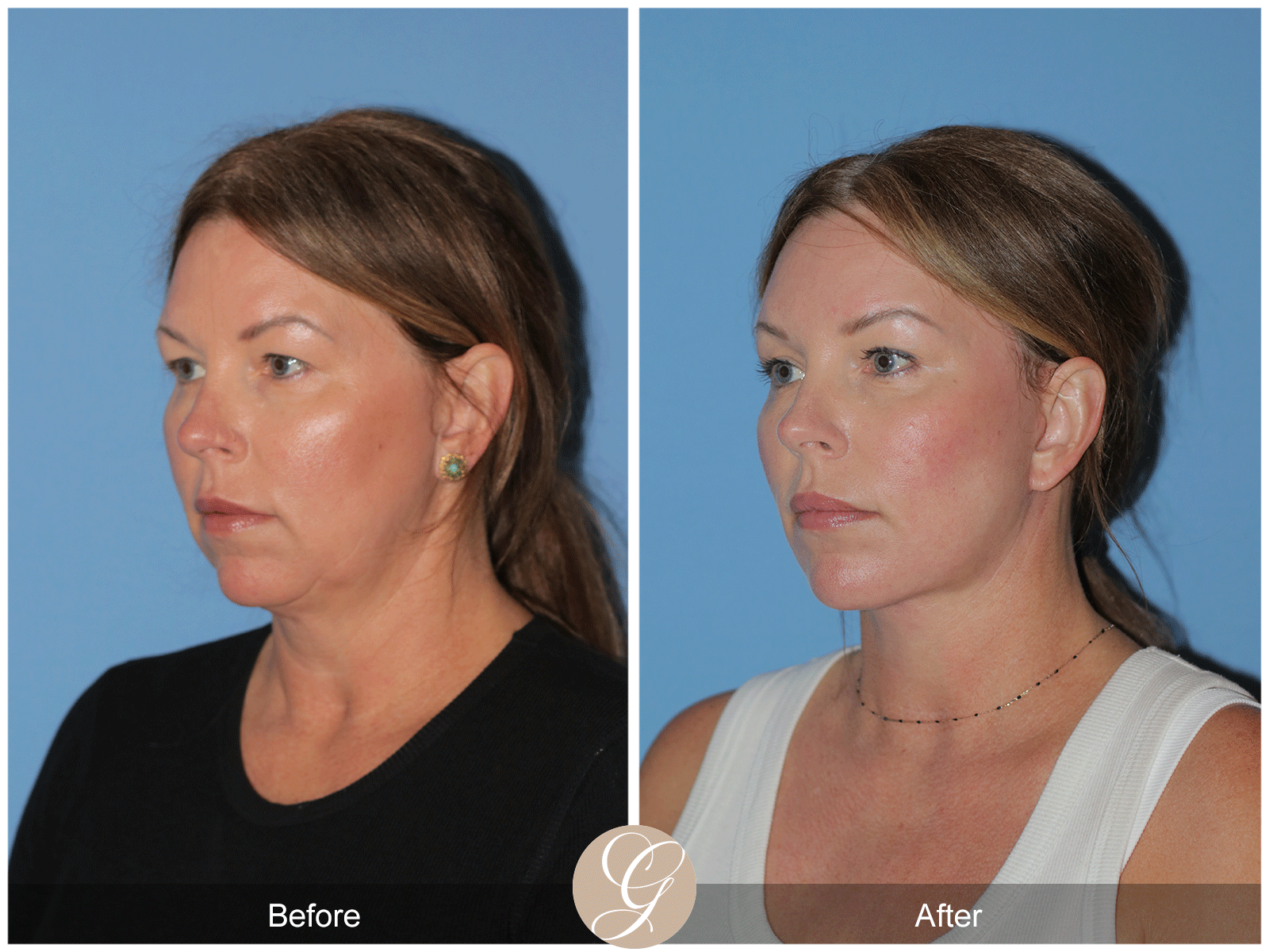 Deep Plane Facelift Case 33 Image