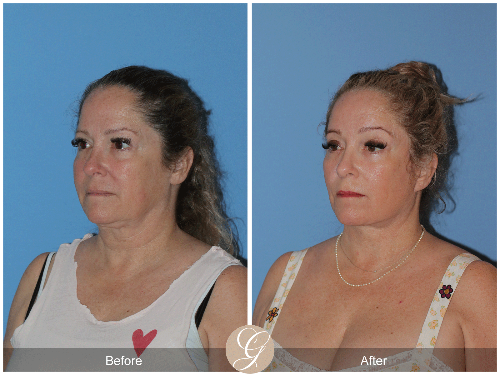 Deep Plane Facelift Case 28 Image