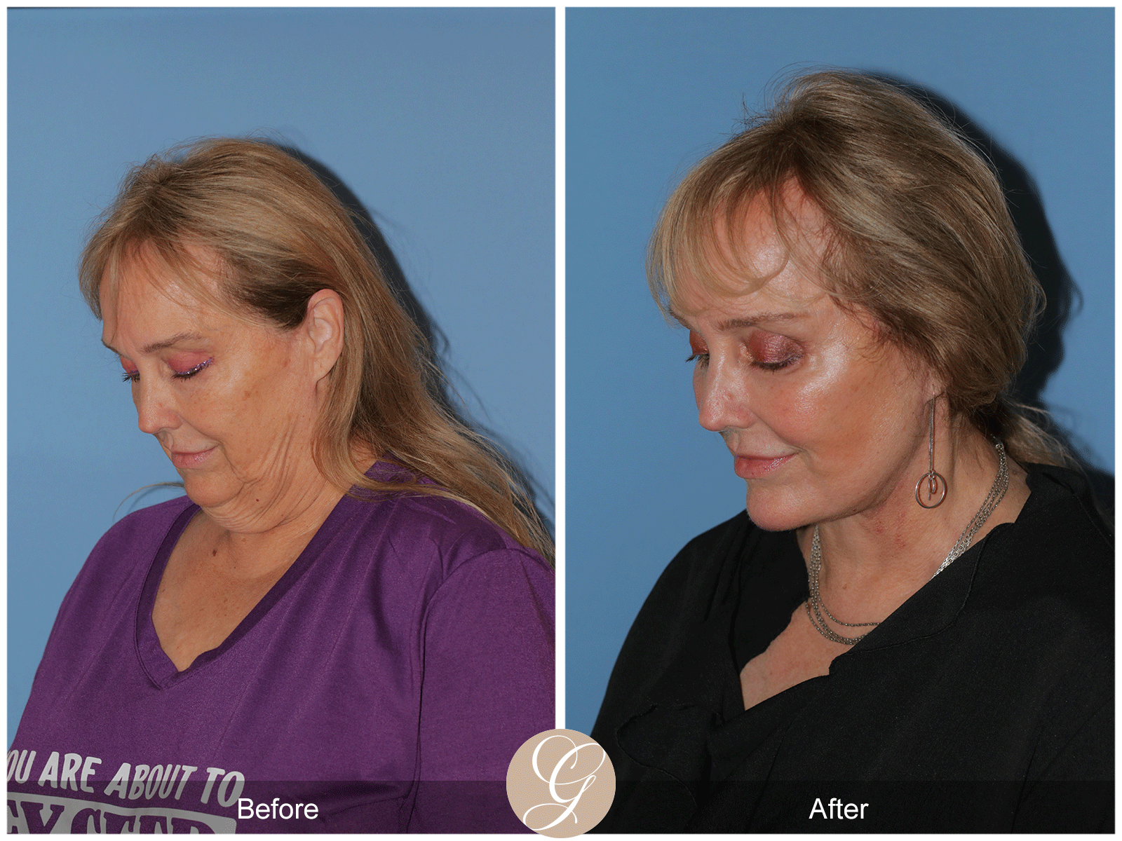 Deep Plane Facelift Case 48 Image