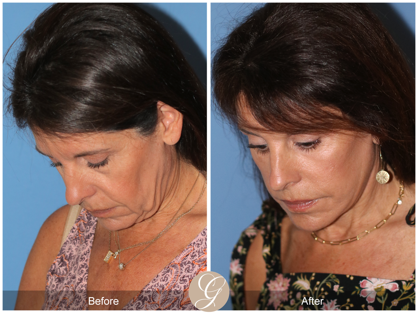 Deep Plane Facelift Case 32 Image