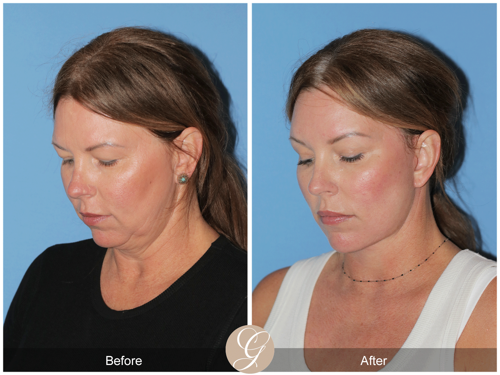 Deep Plane Facelift Case 33 Image