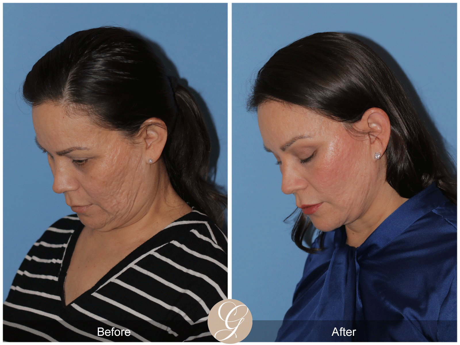 Deep Plane Facelift Case 27 Image