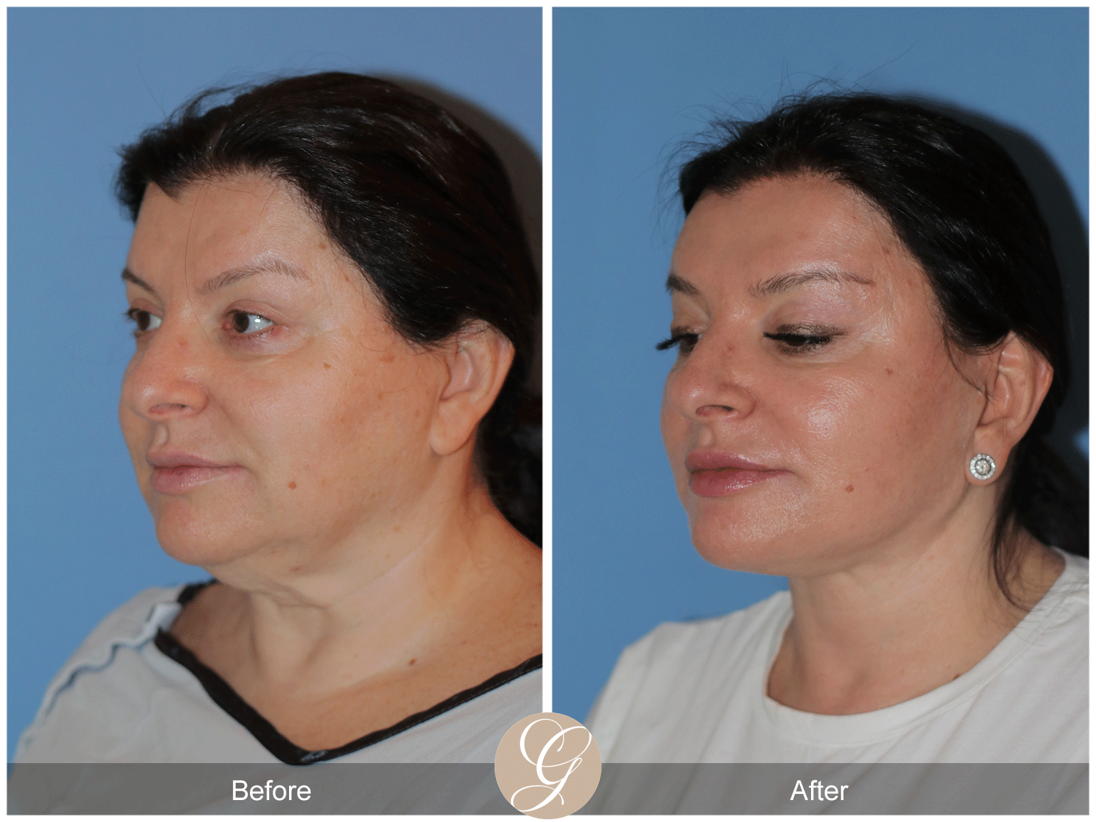 Preservation Deep Plane Facelift Case 40 Image