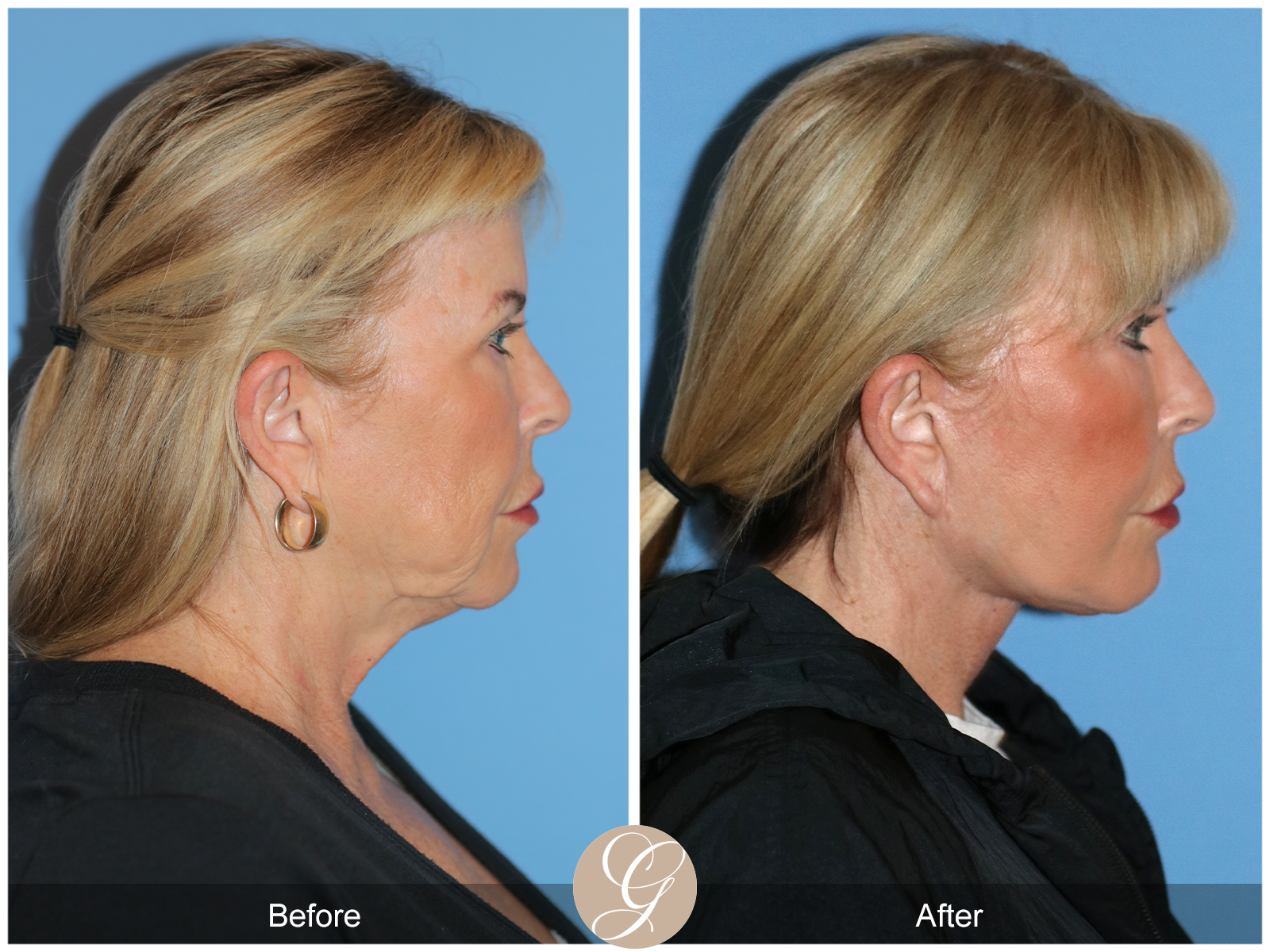 Preservation Deep Plane Facelift Case 35 Image