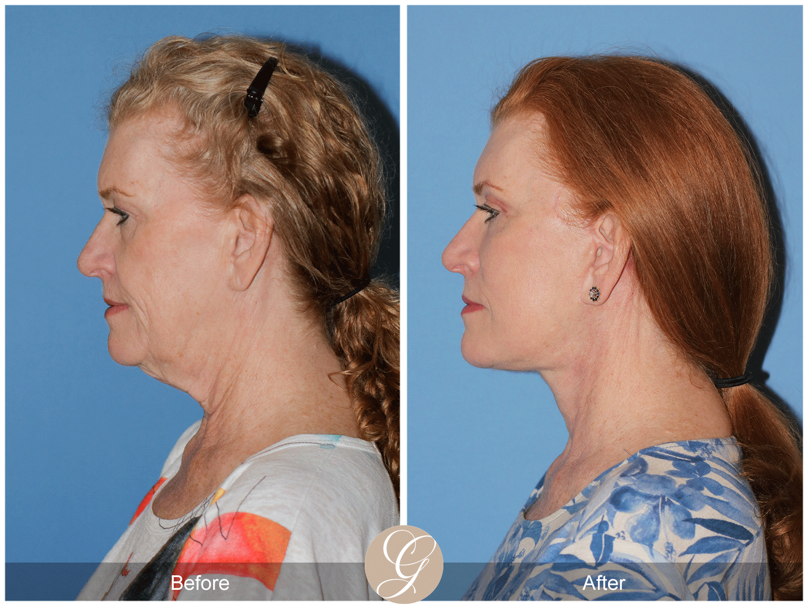 Deep Plane Facelift Case 30 Image