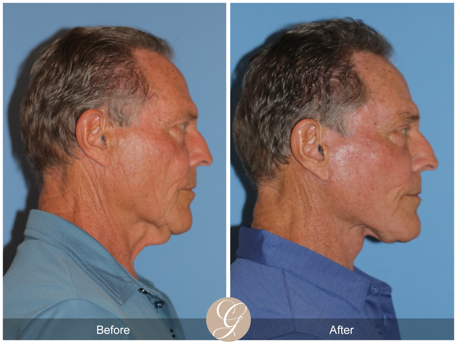 Preservation Deep Plane Facelift Case 36 Image