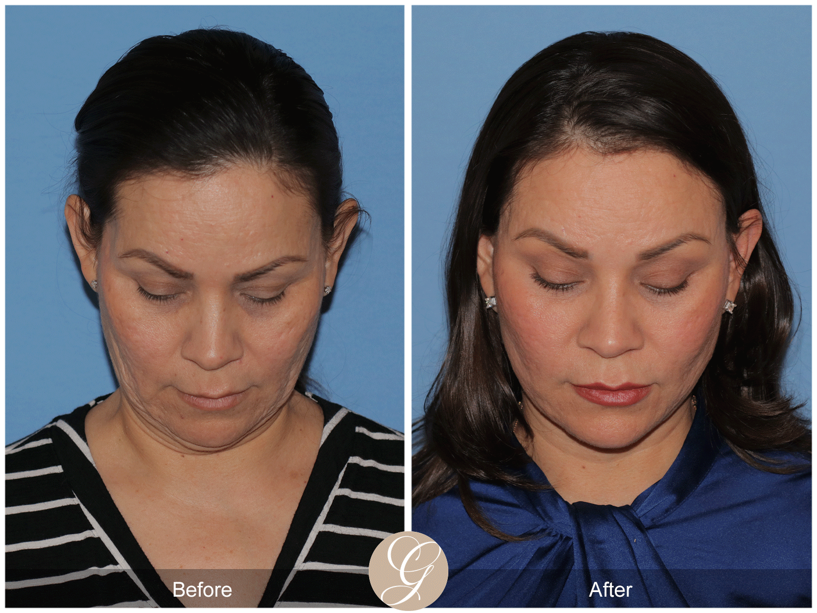 Deep Plane Facelift Case 27 Image
