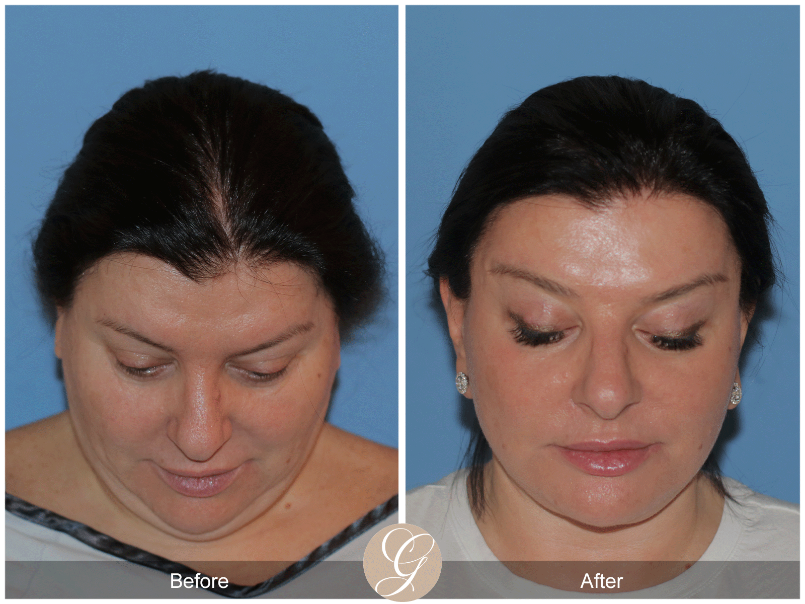 Preservation Deep Plane Facelift Case 40 Image