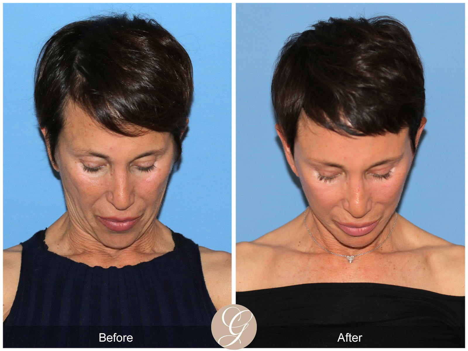 Deep Plane Facelift Case 47 Image