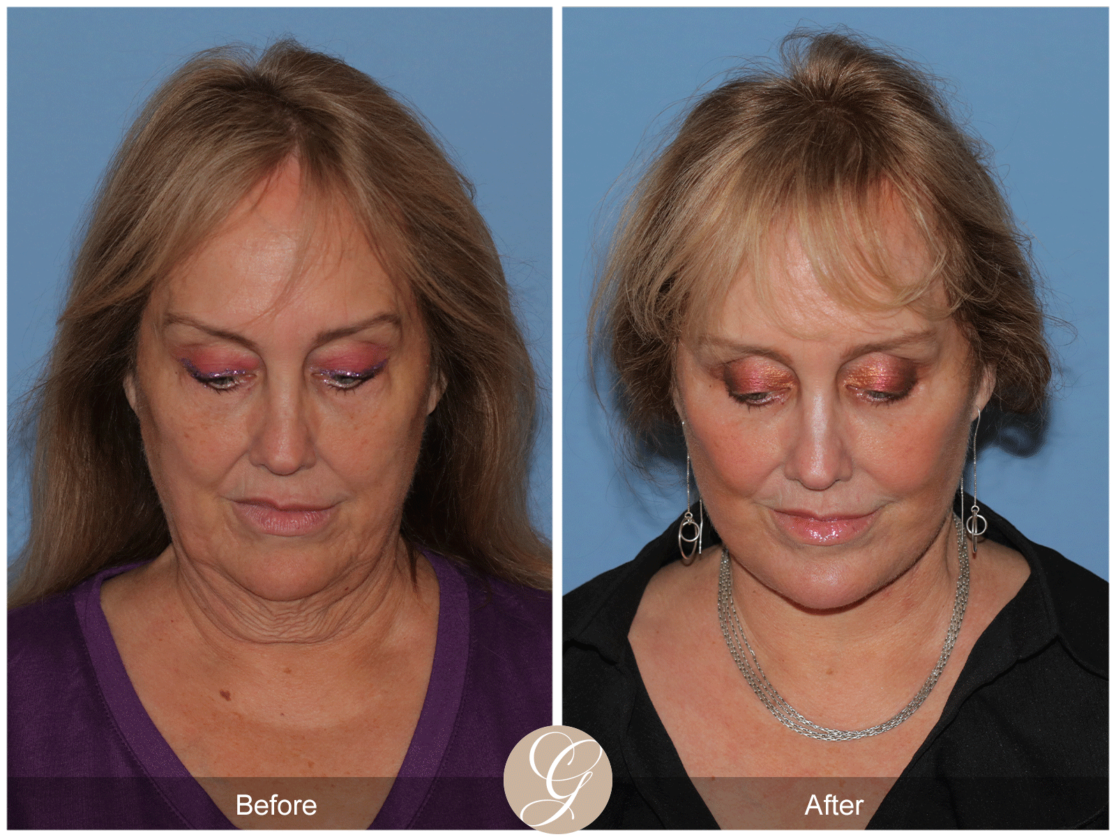 Deep Plane Facelift Case 48 Image