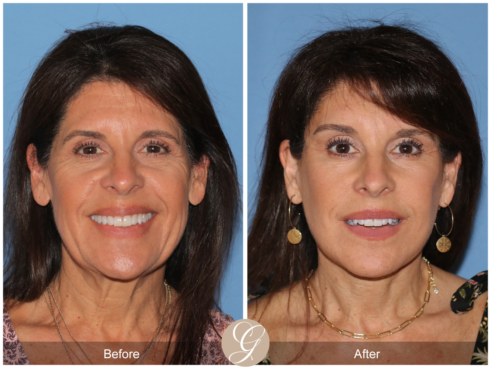 Deep Plane Facelift Case 32 Image