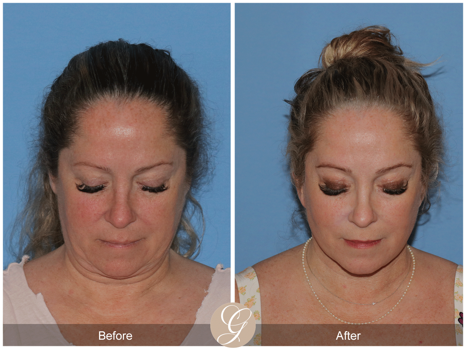 Deep Plane Facelift Case 28 Image