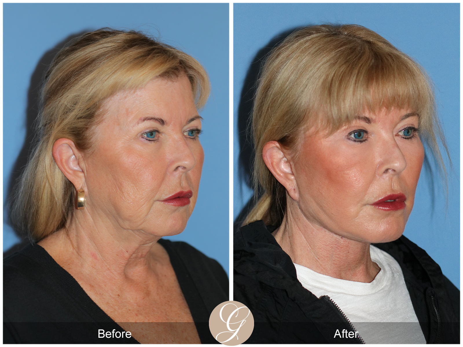 Preservation Deep Plane Facelift Case 35 Image