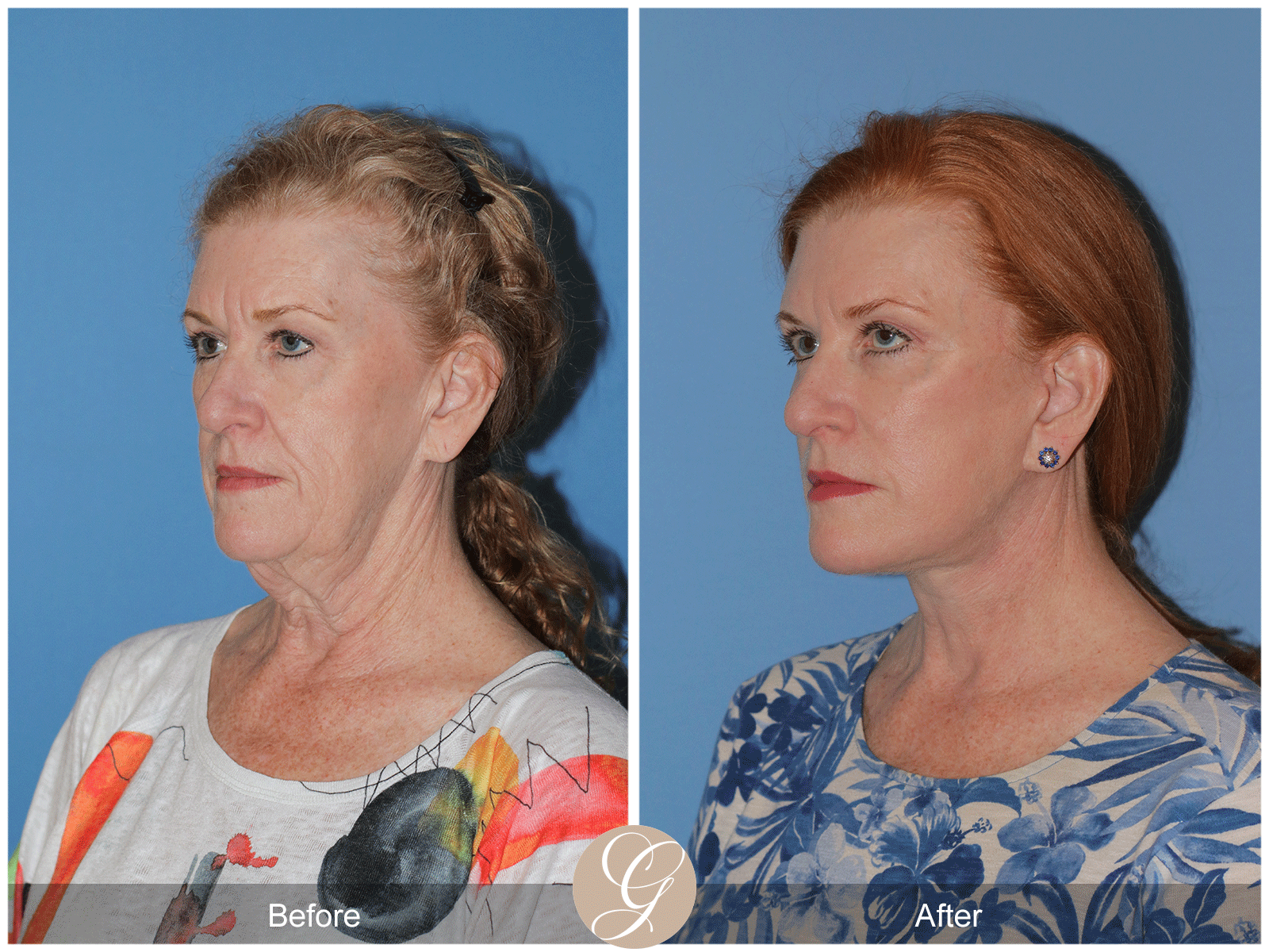 Deep Plane Facelift Case 30 Image