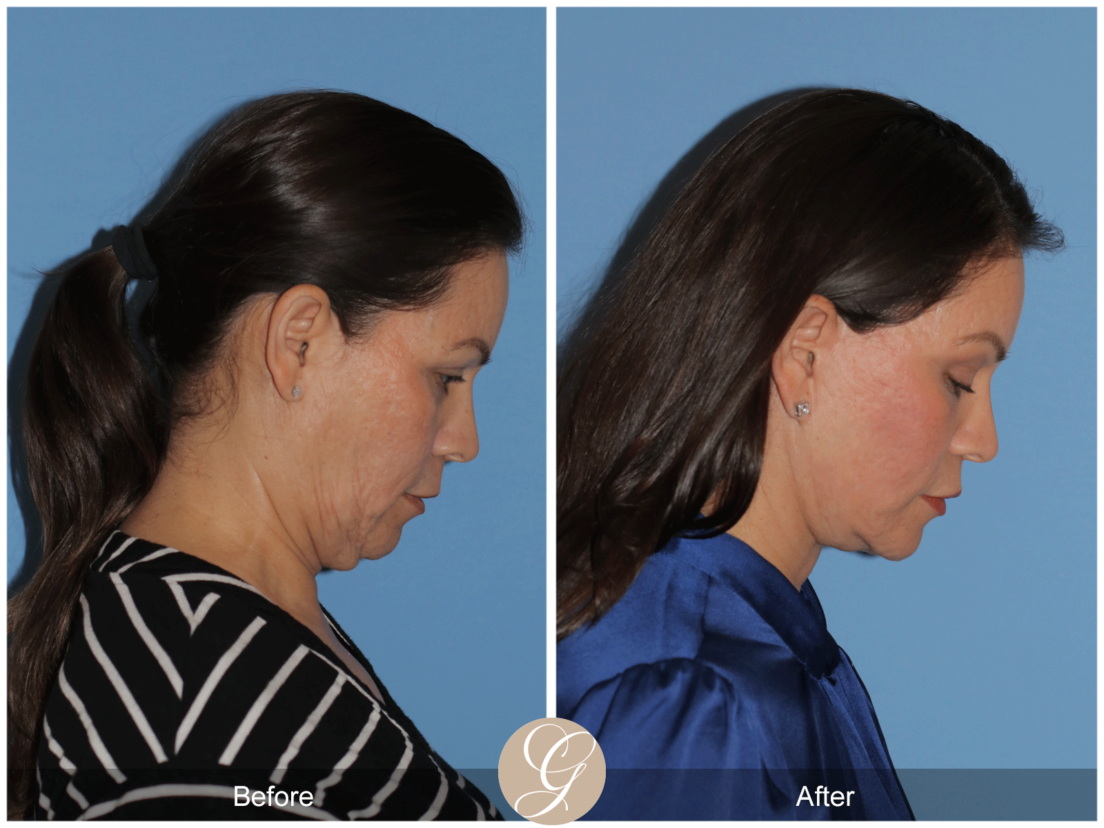 Deep Plane Facelift Case 27 Image