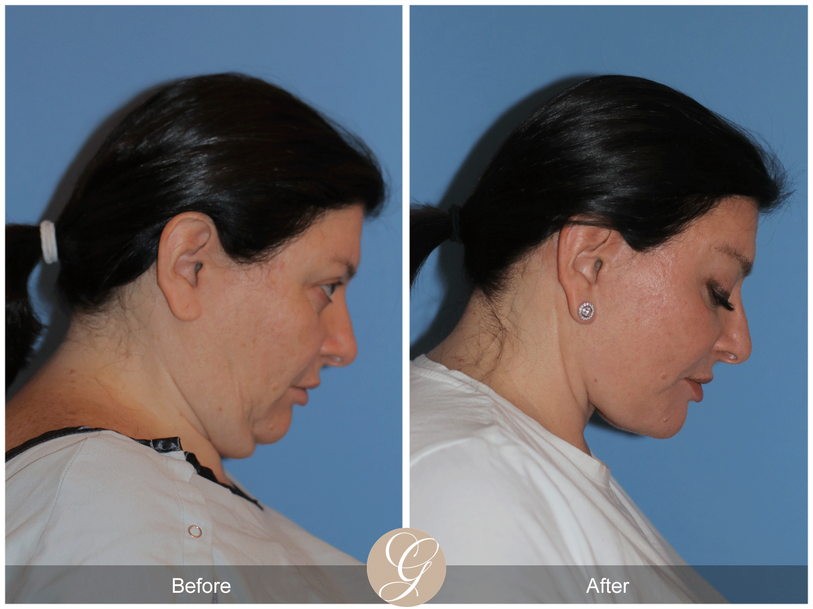 Preservation Deep Plane Facelift Case 40 Image