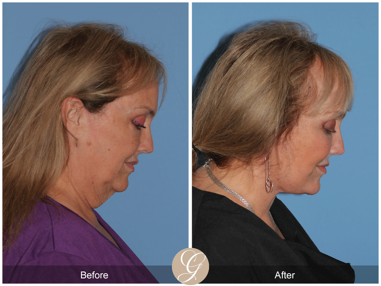 Deep Plane Facelift Case 48 Image