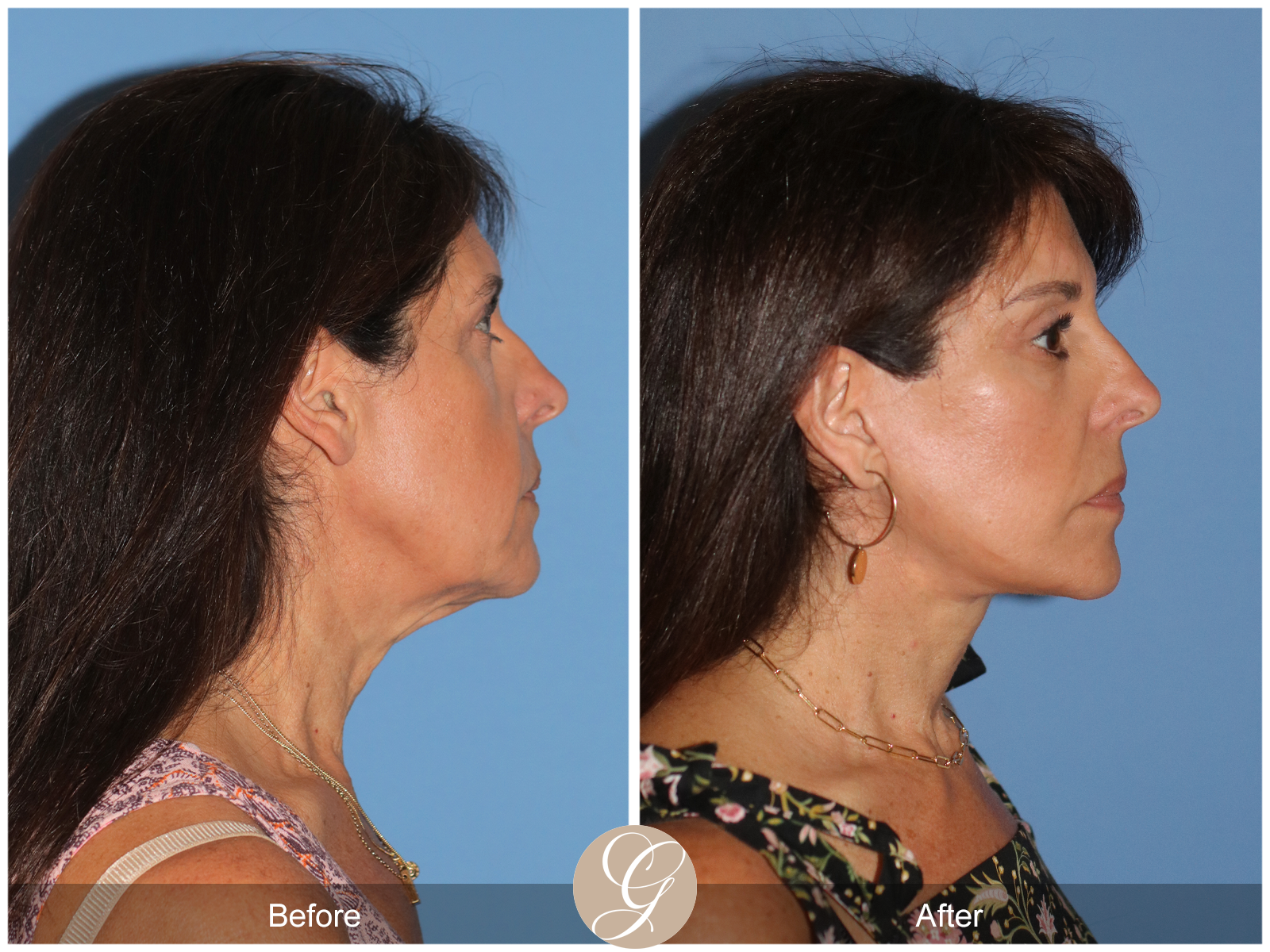 Deep Plane Facelift Case 32 Image