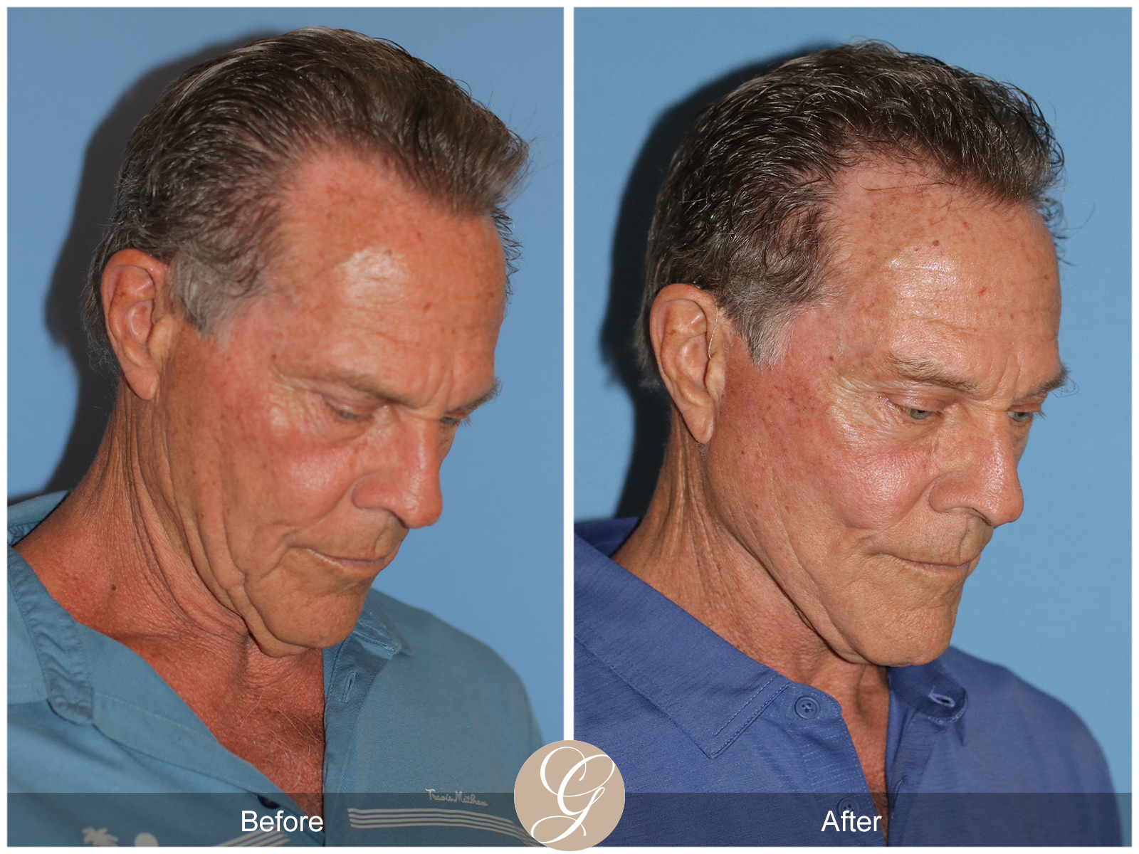 Preservation Deep Plane Facelift Case 36 Image