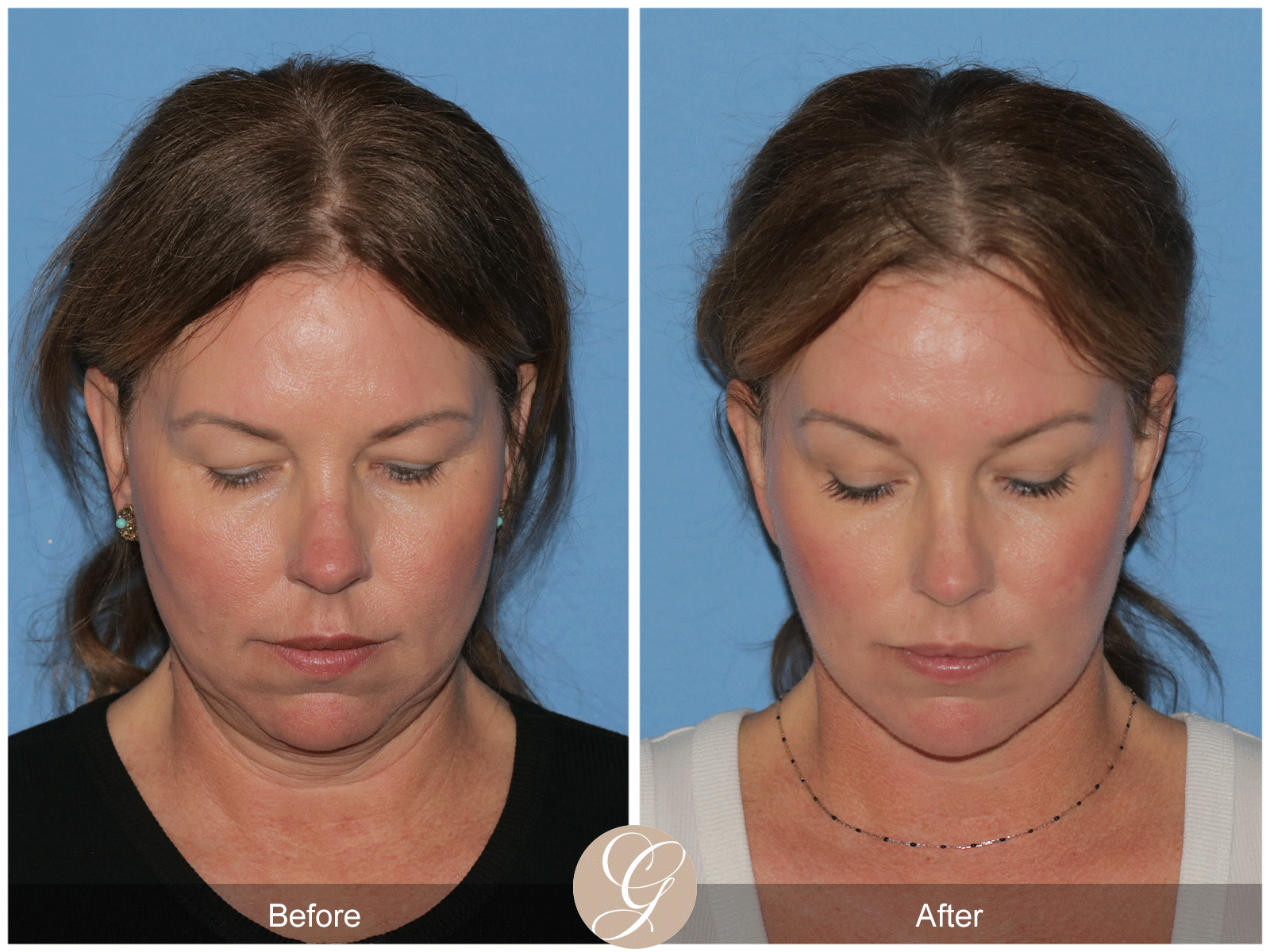 Deep Plane Facelift Case 33 Image