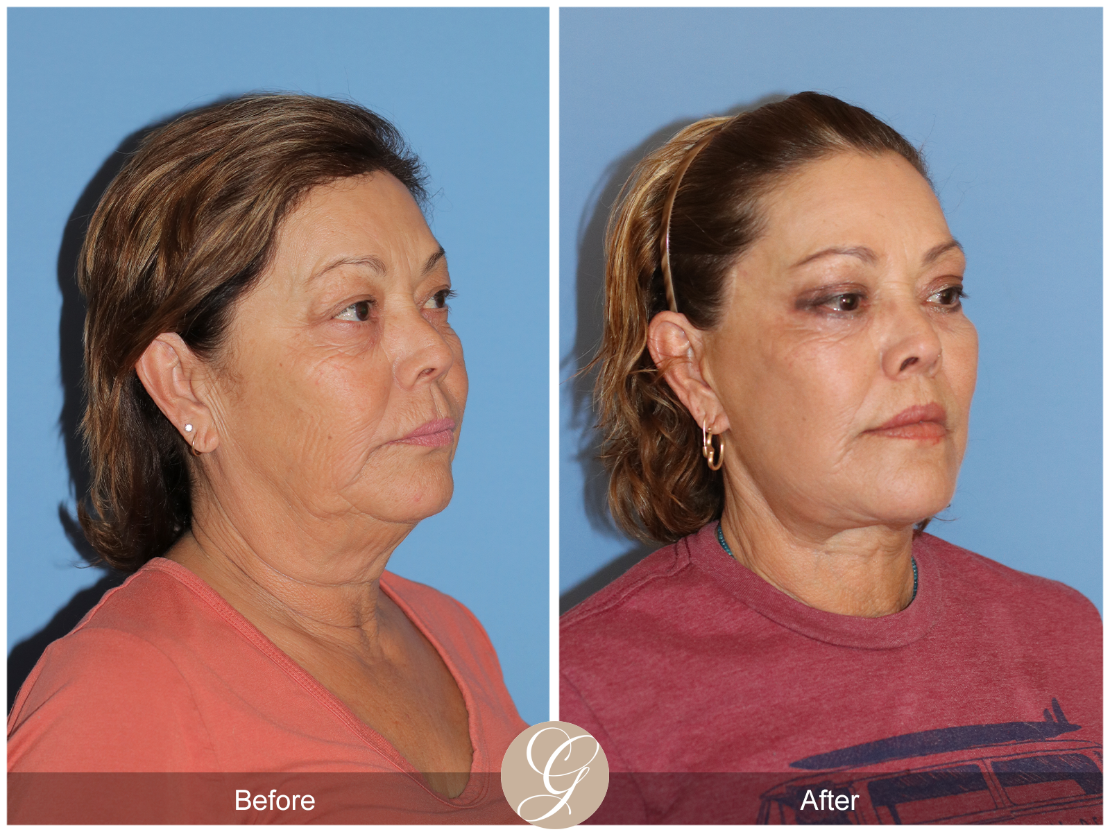 Deep Plane Facelift Case 37 Image