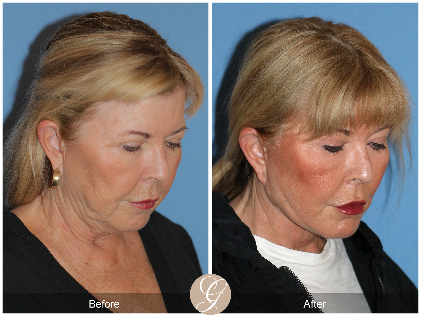 Preservation Deep Plane Facelift Case 35 Image