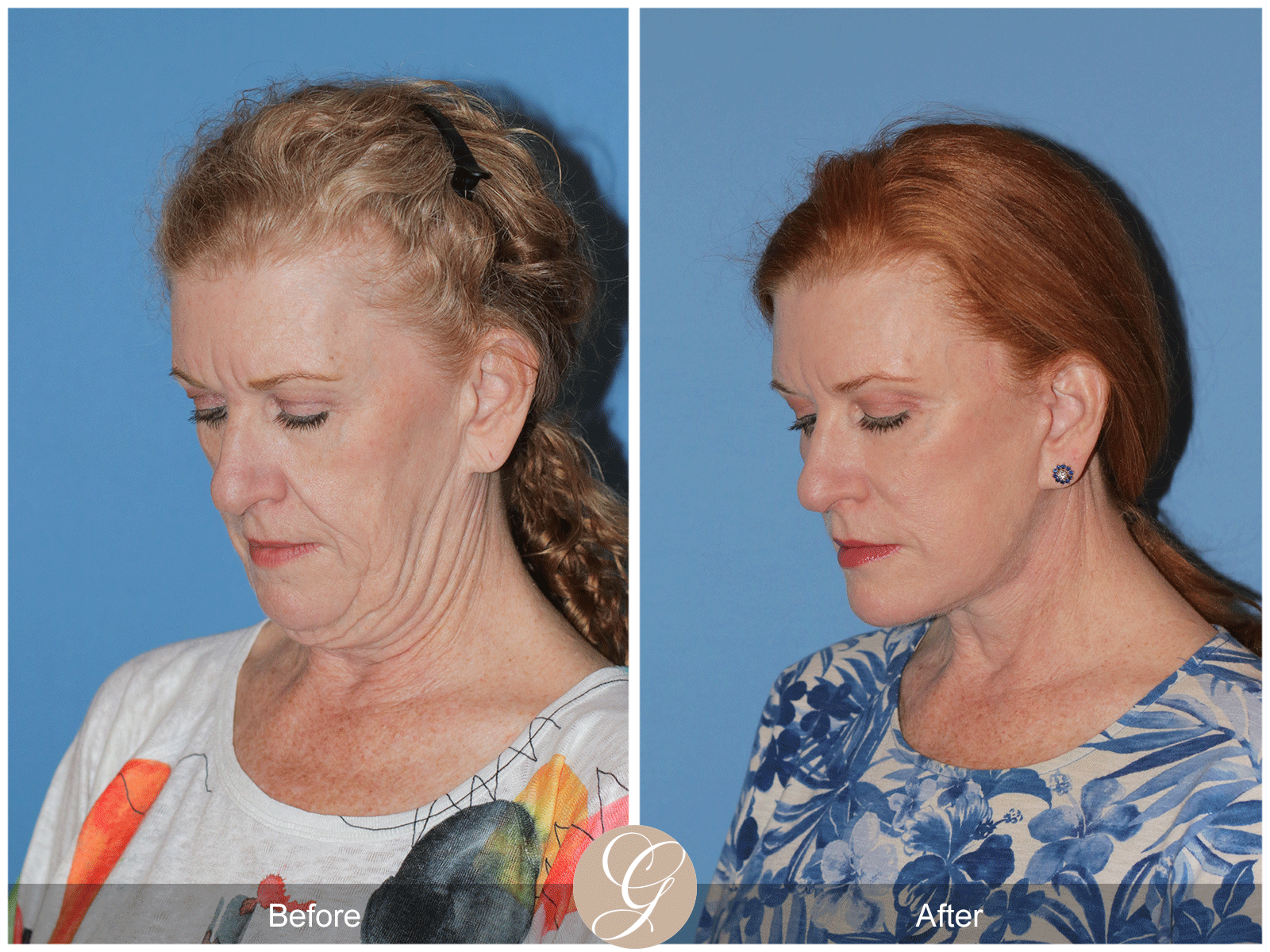 Deep Plane Facelift Case 30 Image