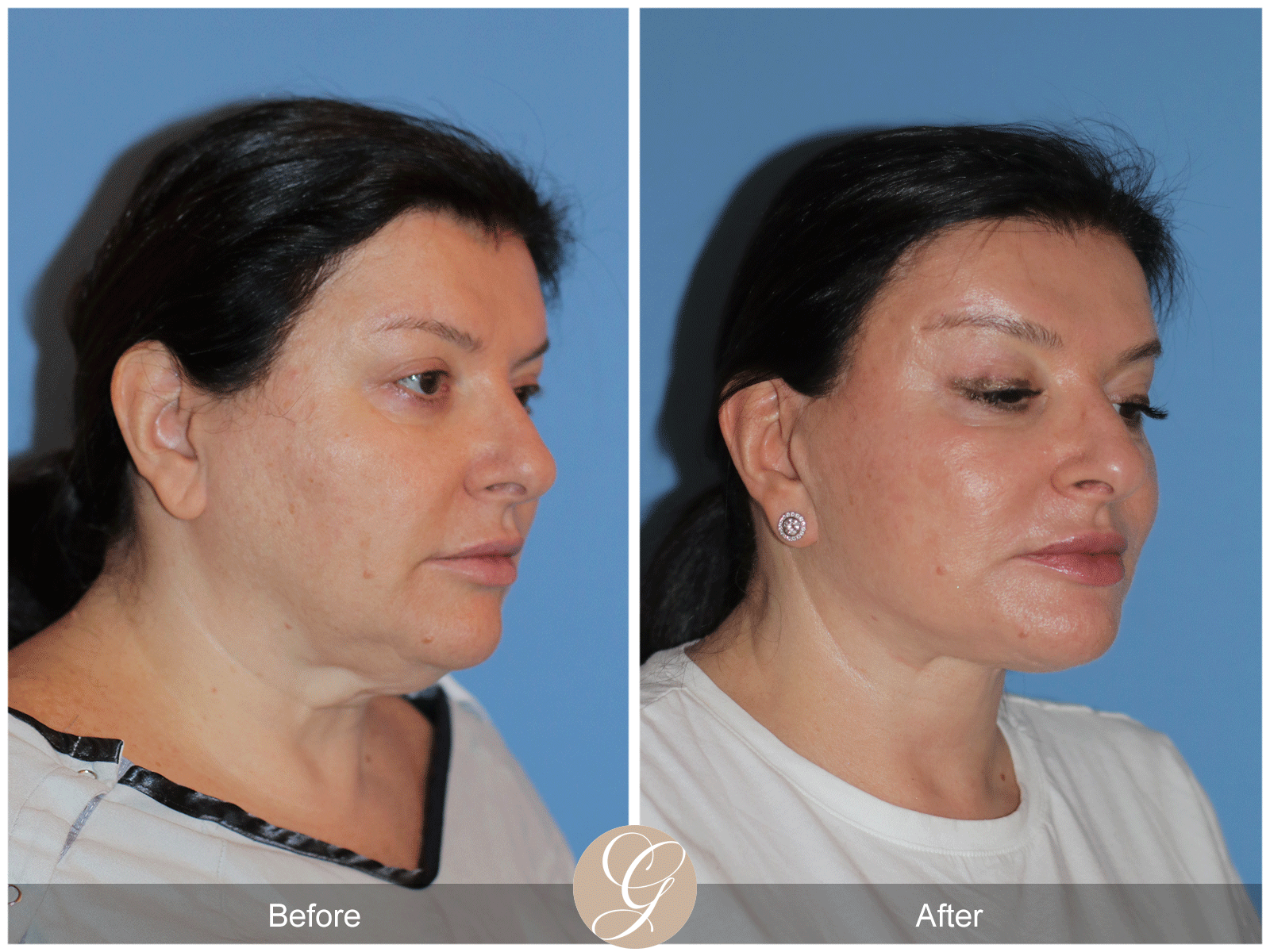 Preservation Deep Plane Facelift Case 40 Image