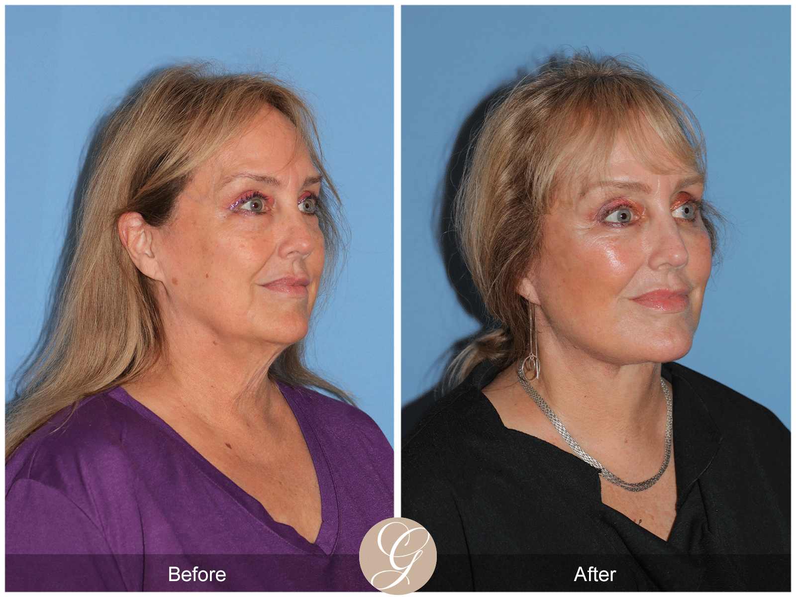 Deep Plane Facelift Case 48 Image