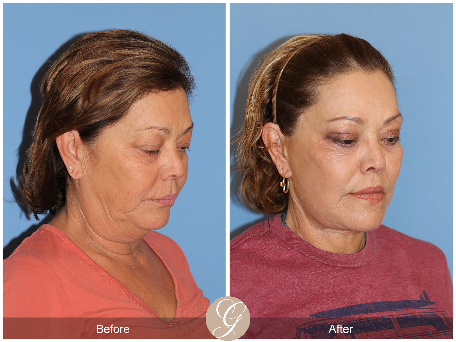 Deep Plane Facelift Case 37 Image