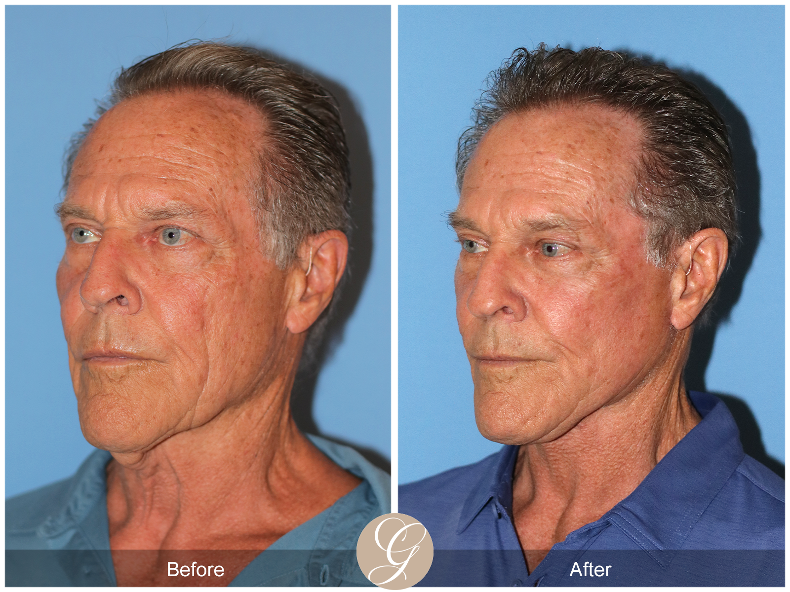 Preservation Deep Plane Facelift Case 36 Image