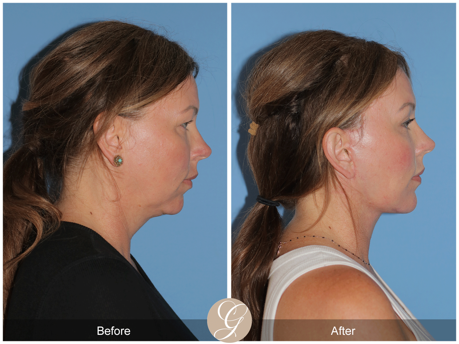 Deep Plane Facelift Case 33 Image