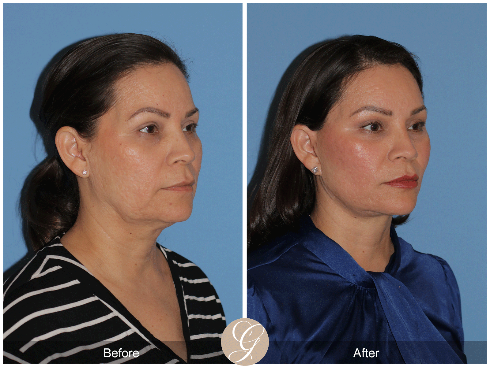 Deep Plane Facelift Case 27 Image