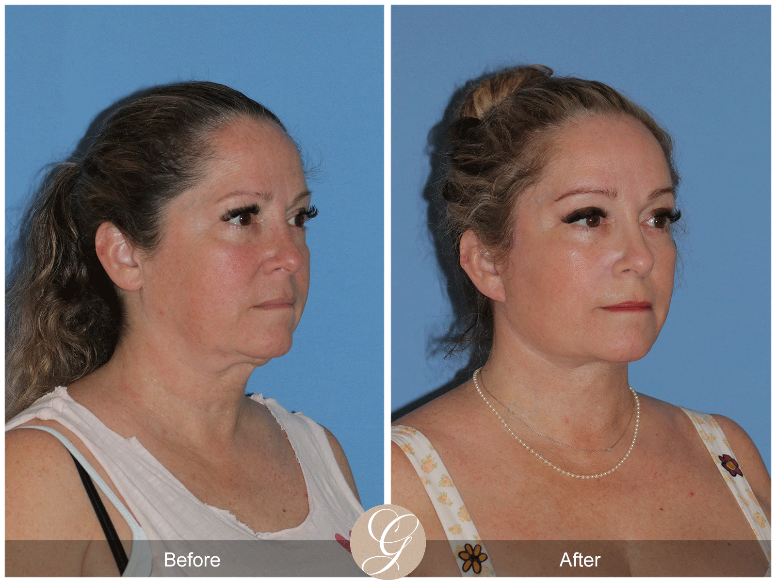 Deep Plane Facelift Case 28 Image
