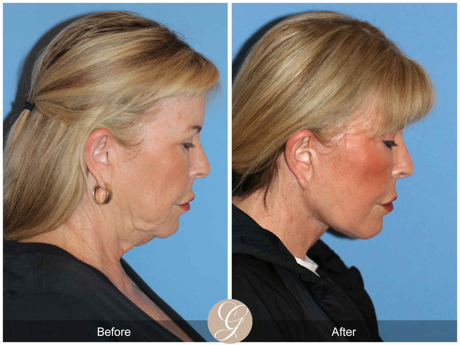 Preservation Deep Plane Facelift Case 35 Image