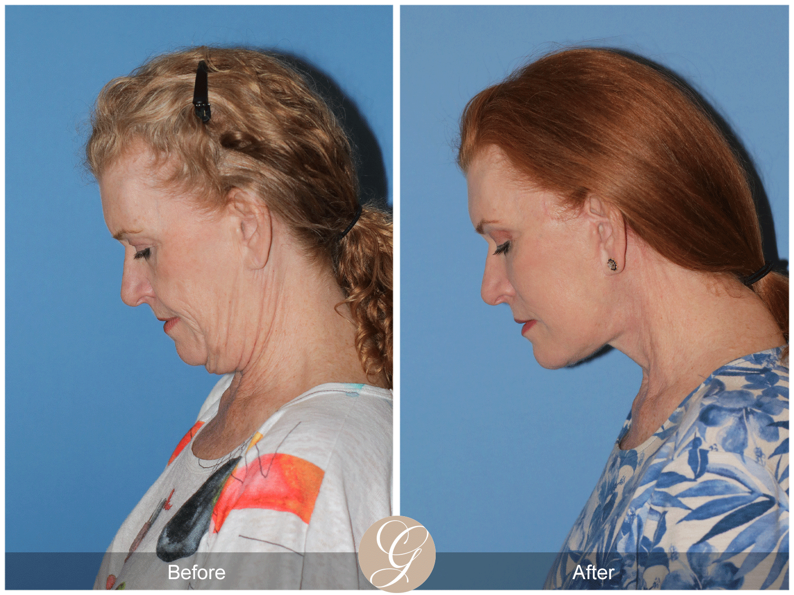 Deep Plane Facelift Case 30 Image