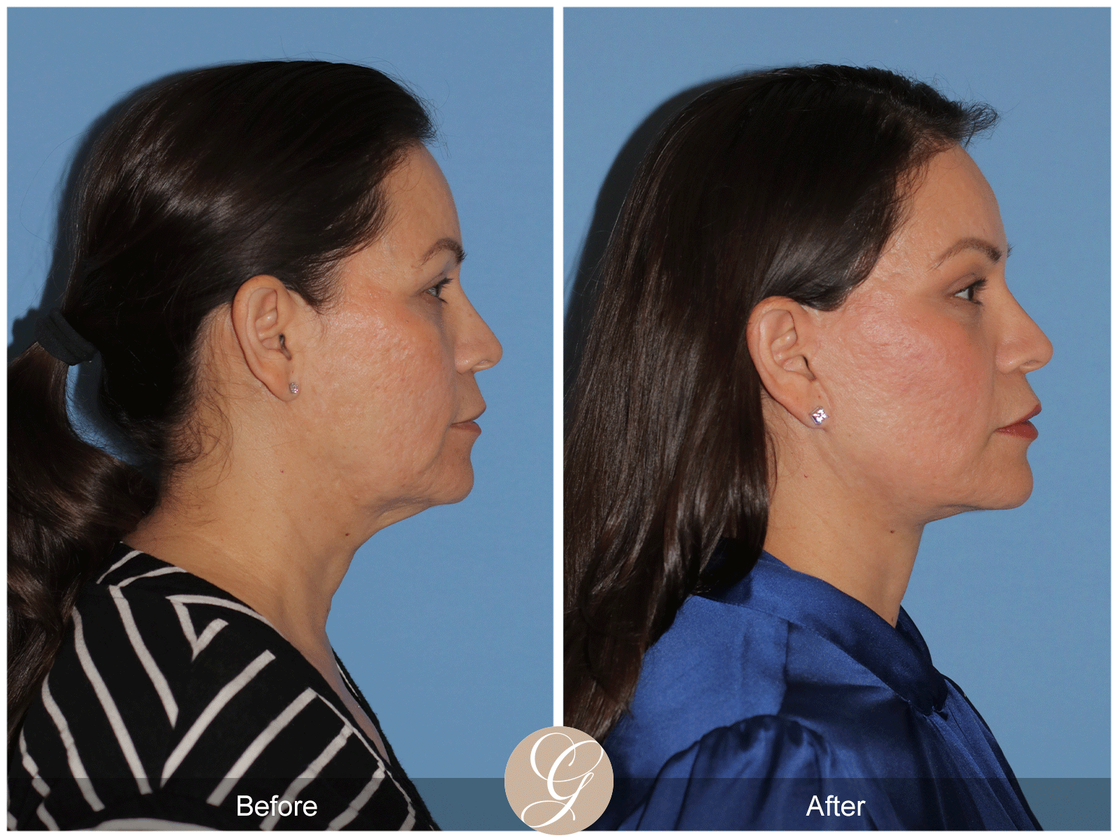 Deep Plane Facelift Case 27 Image