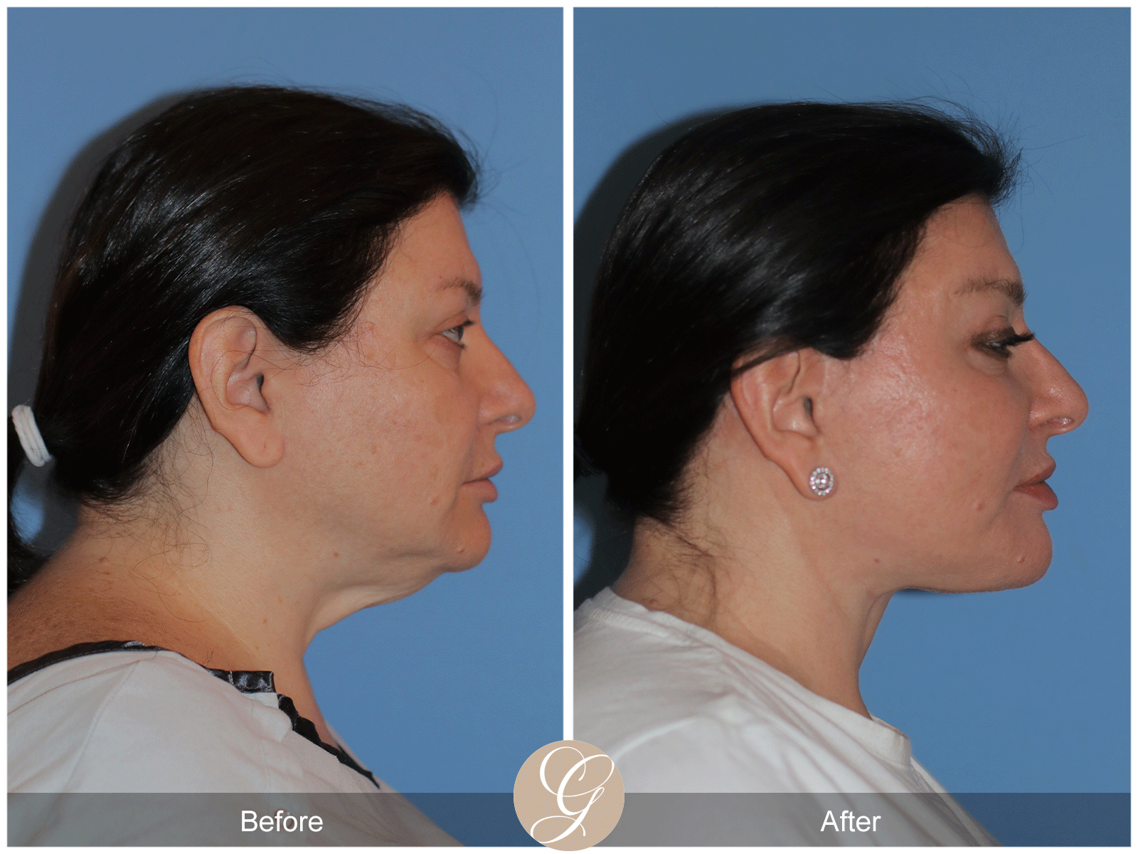 Preservation Deep Plane Facelift Case 40 Image