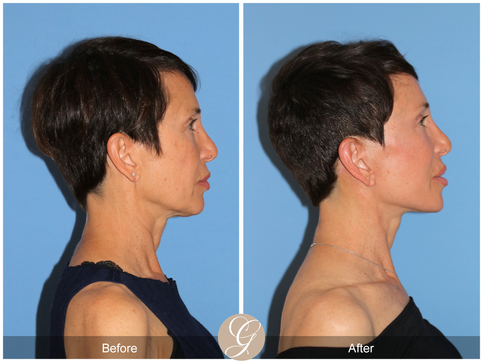Deep Plane Facelift Case 47 Image