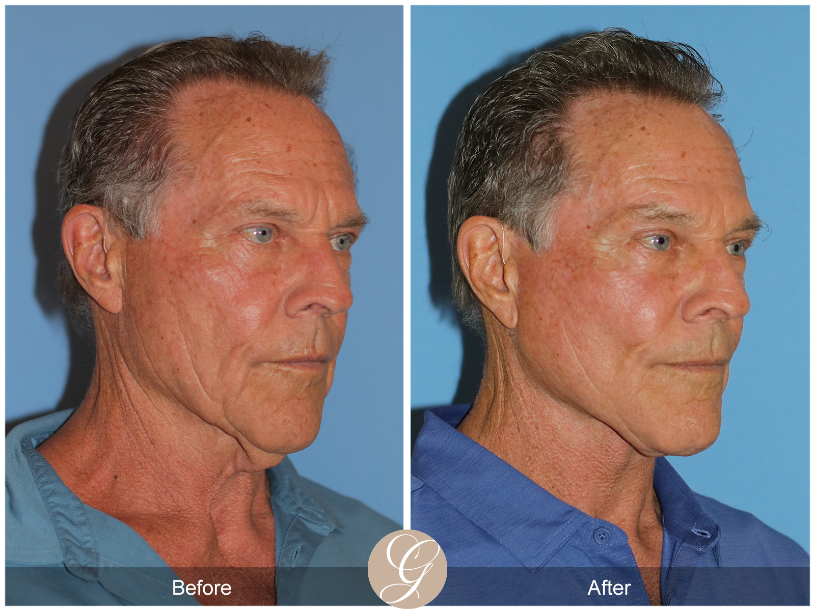 Preservation Deep Plane Facelift Case 36 Image